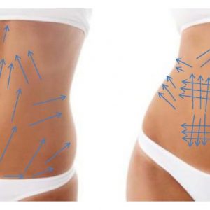 Tratamientos contra la celulitis