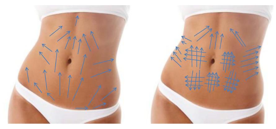 Tratamientos contra la celulitis