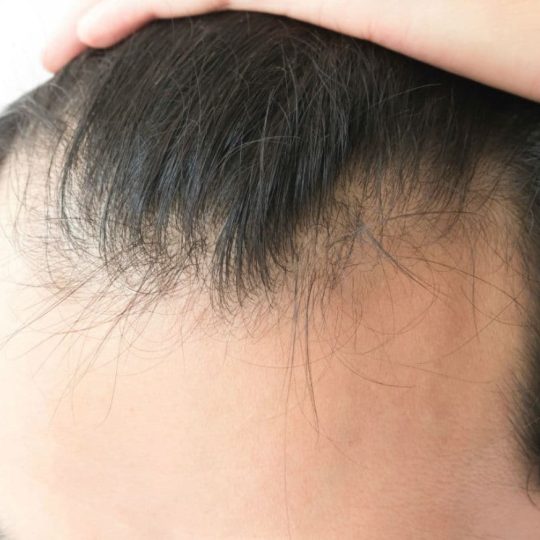 Alopecia-androgenica-caracteristicas-y-tratamientos