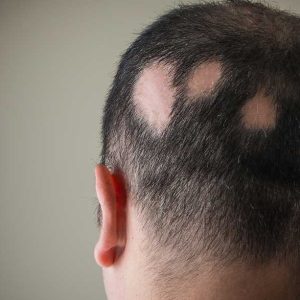 alopecia areata