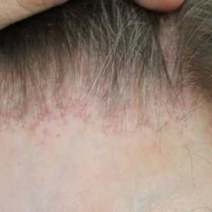 alopecia-frontal-fibrosante