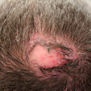 foliculitis-decalvante