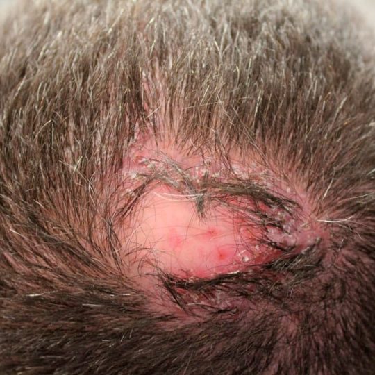 foliculitis-decalvante