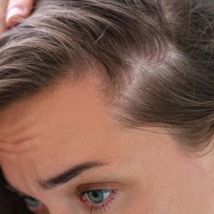 que-es-alopecia-androgenetica-mujer-1